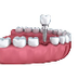 Dental Implant services
