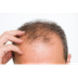 Some Advisable For Hair Loss