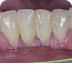 Placa bacteriana supragingival