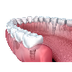 Dental implant Melbourne