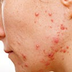 Medical Coding for Acne