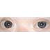 Down syndrome eyes
