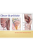 Cáncer de próstata: Tratamient