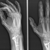 Röntgenfoto van een hand | Nat