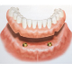 Denture Implants | Implant Den