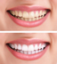 Teeth Whitening, Dental Whiten