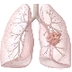 Lung Cancer Medical Coding