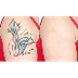 know about laser tattoo remova