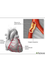 Aterosclerosis: MedlinePlus en