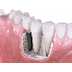 dental implants dandenong