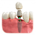 Your Dental Implant Surgery