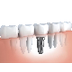 Choose an expert Dental implan