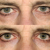 How Much Does Eye Lift Surgery