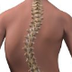 Scoliosis: What You Need to Kn