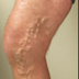 Vein Treatment: Can Leg Wedge