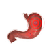 Gastritis, trastornos del esto