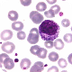 Leucemia GRUPO.5.4