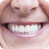 Complete Dentures In One Day