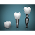 Dental Implant 