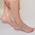 How do you treat spider veins?