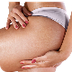 Stretch Mark Removal Treatment