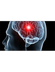 Accidente cerebrovascular - Qu