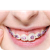 Can kids use Invisalign?