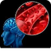 Demencia vascular