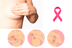 Tipos de cáncer de mama - UDM