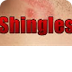 Shingles -